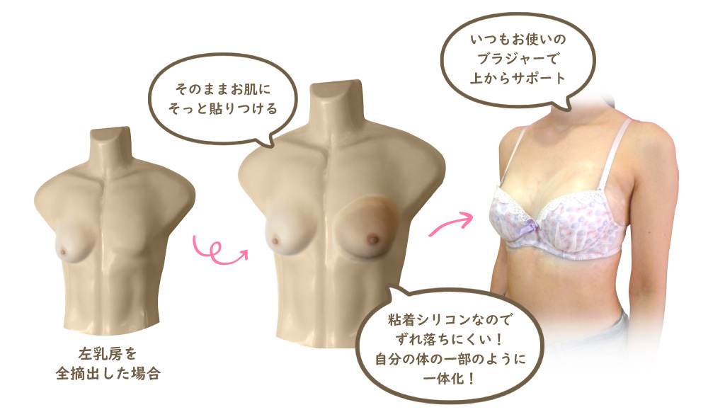 装着式人工乳房 メディケアブレスト Mサイズ ブラジャーb Cカップ相当 株式会社レリエンスメディケア 装着式人工乳房 メディケアブレスト Mサイズ ブラジャーb Cカップ相当 株式会社レリエンスメディケア
