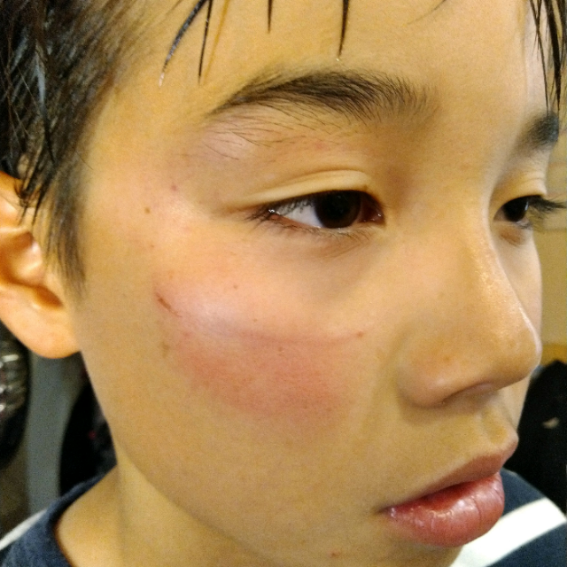 スポーツサングラスは子供に必要か？「眼のケガの予防」②