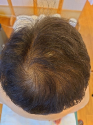 薄毛（男性型脱毛症が疑われる症例）に対する鍼灸施術の経過報告