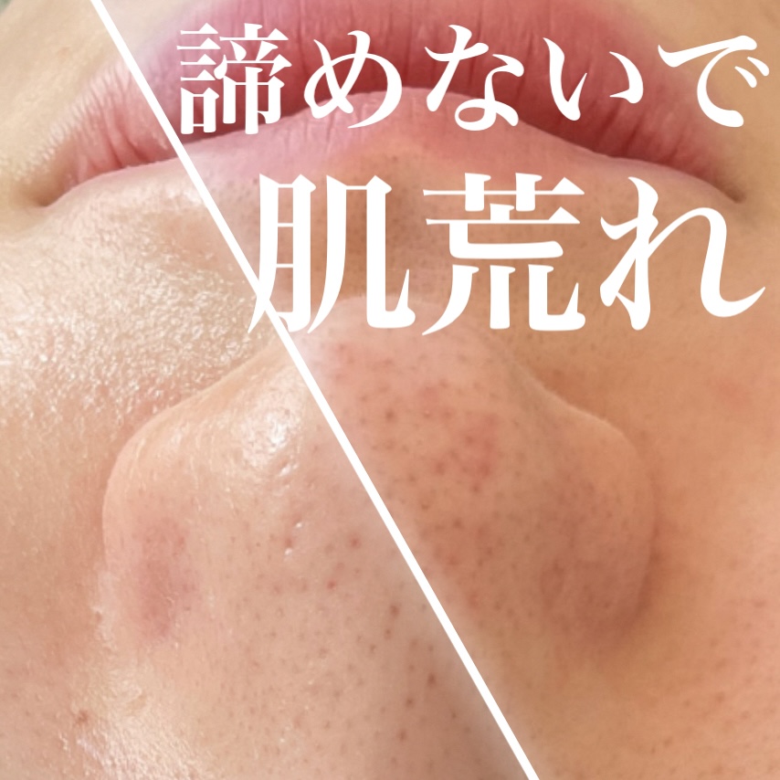 花粉！乾燥！敏感肌さんへのスキンケアポイント💡