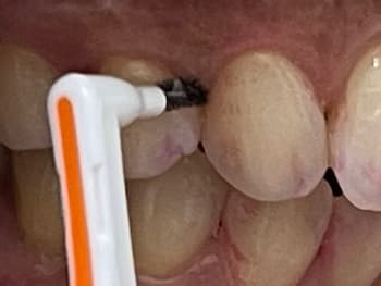 歯と歯の間こそ磨くべし！～歯間ブラシ