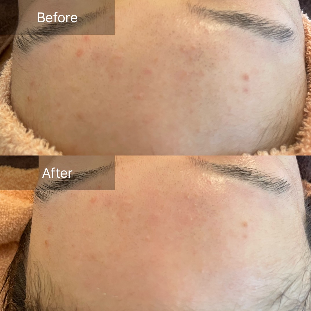 【敏感肌】クレイパックで肌荒れ改善💫