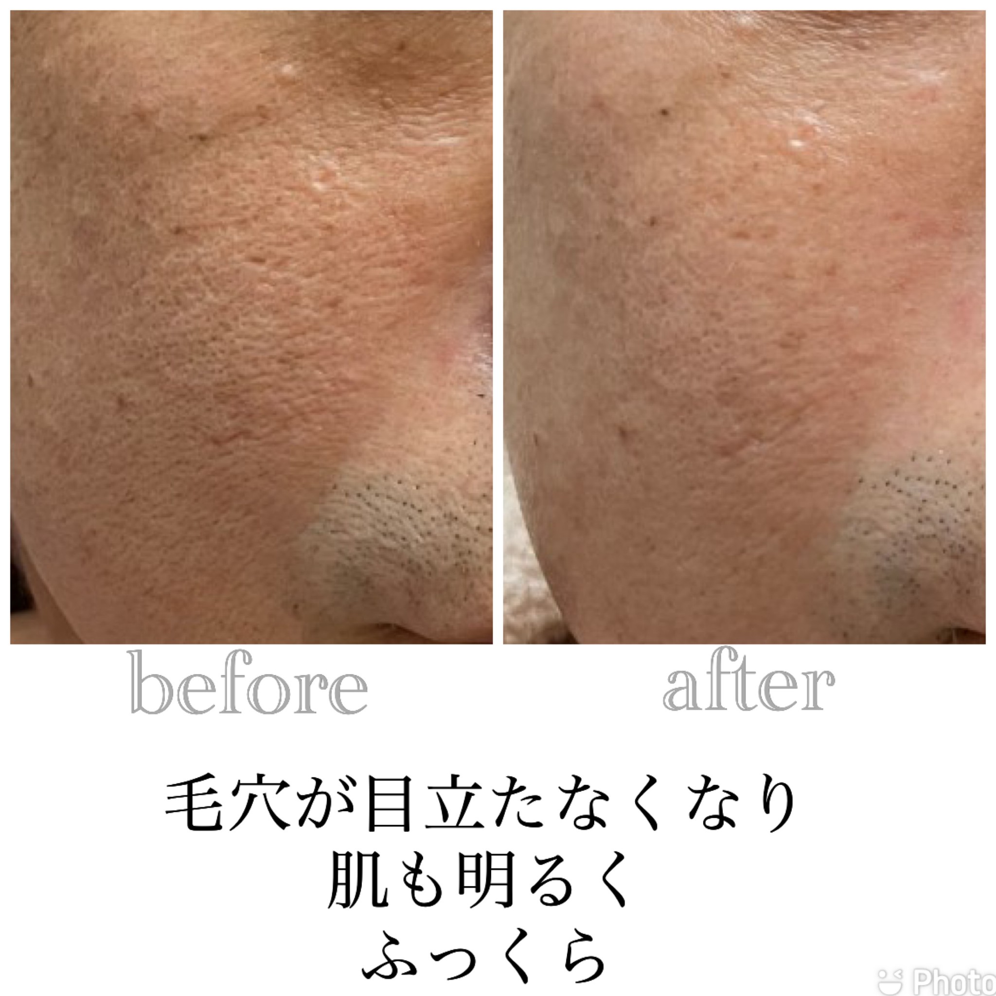 クレイパックでキメも整いリフトアップ