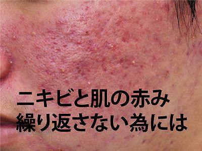 【脂漏性皮膚の処方される薬は抗生物質や抗菌剤。中にはステロイドも】