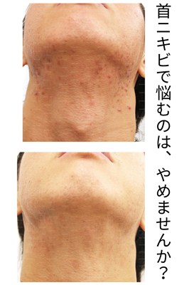 首のニキビ　対策事例