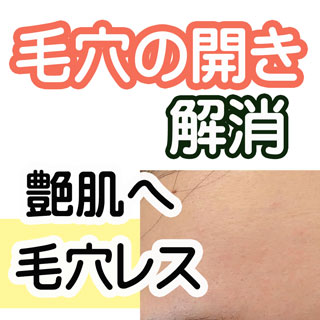 毛穴の開き・毛穴の黒ずみを解消へ