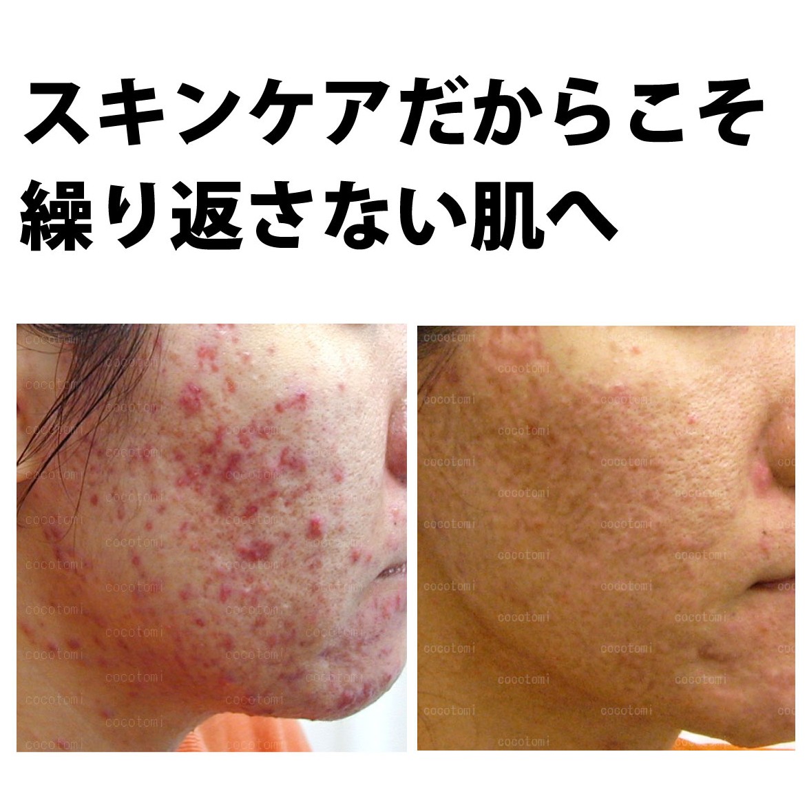 ニキビを繰り返さない肌にするには