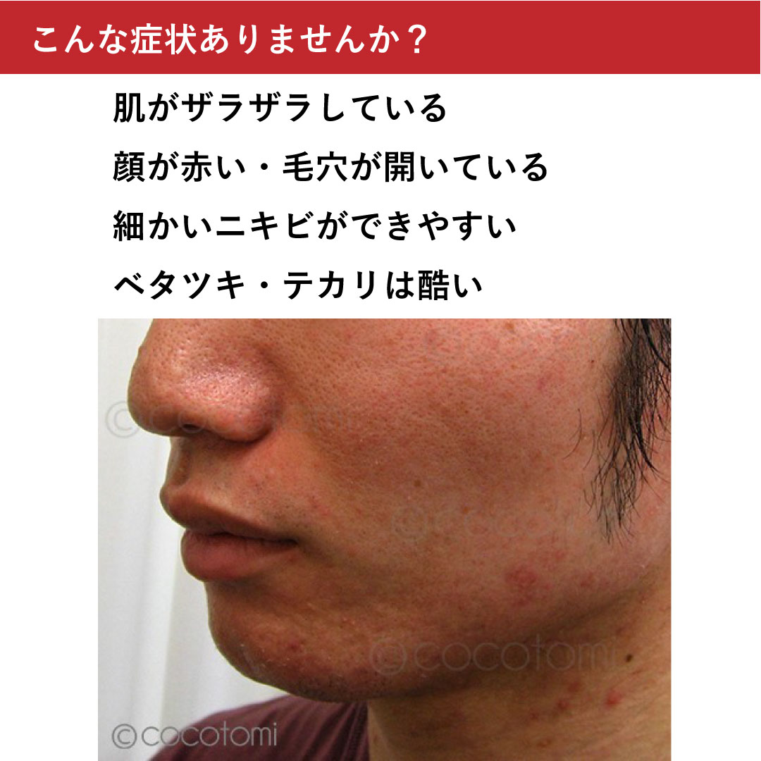 毛穴の開き・肌の赤み・脂漏性肌の対策