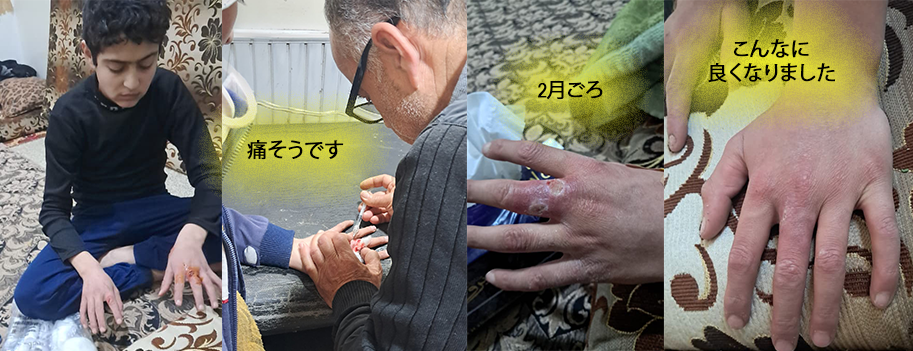 サラーハ君の手術が無事に終わりました。