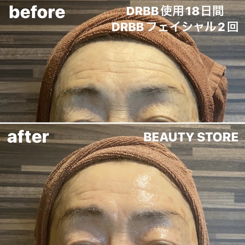 DRBB使用のbefore・after(額のシワ)
