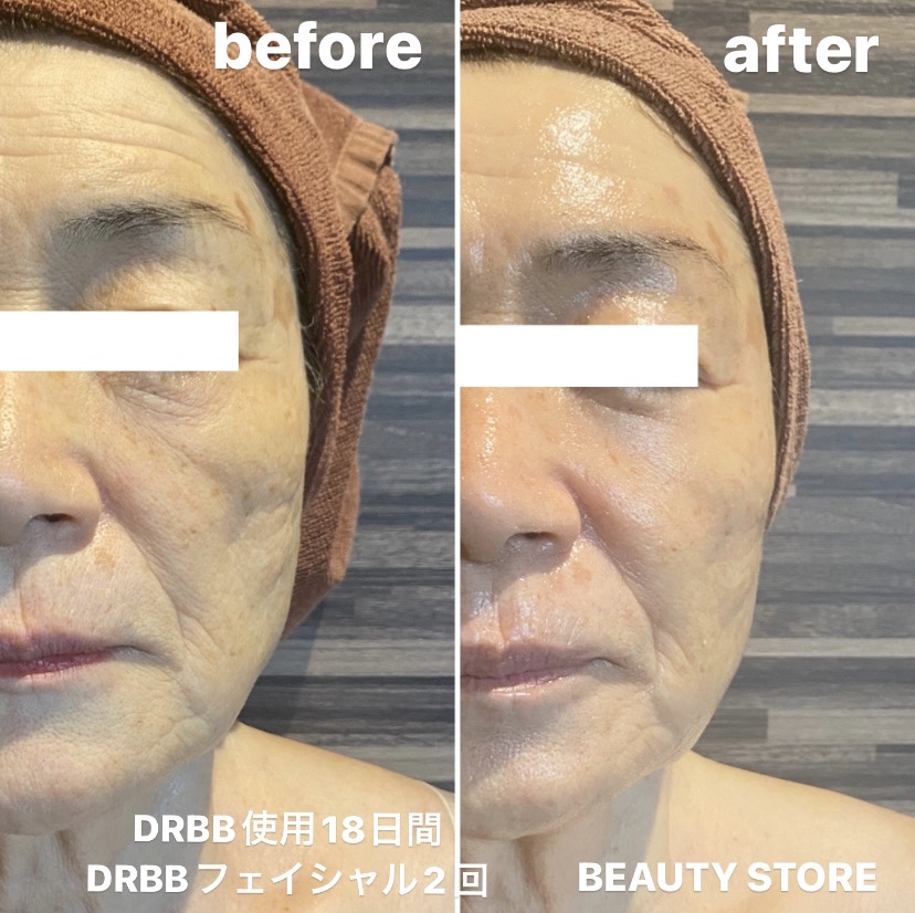 DRBB使用のbefore・after(シワ・たるみ)