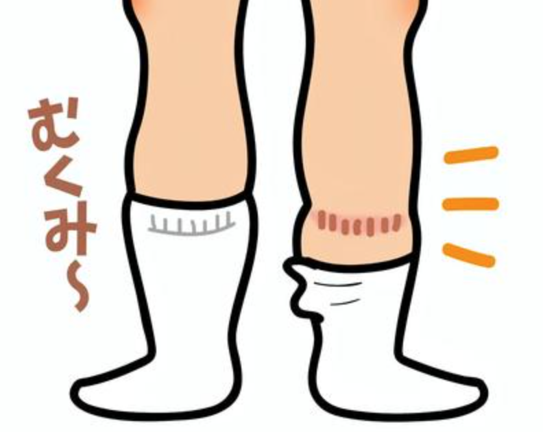 なぜむくみやすいの???