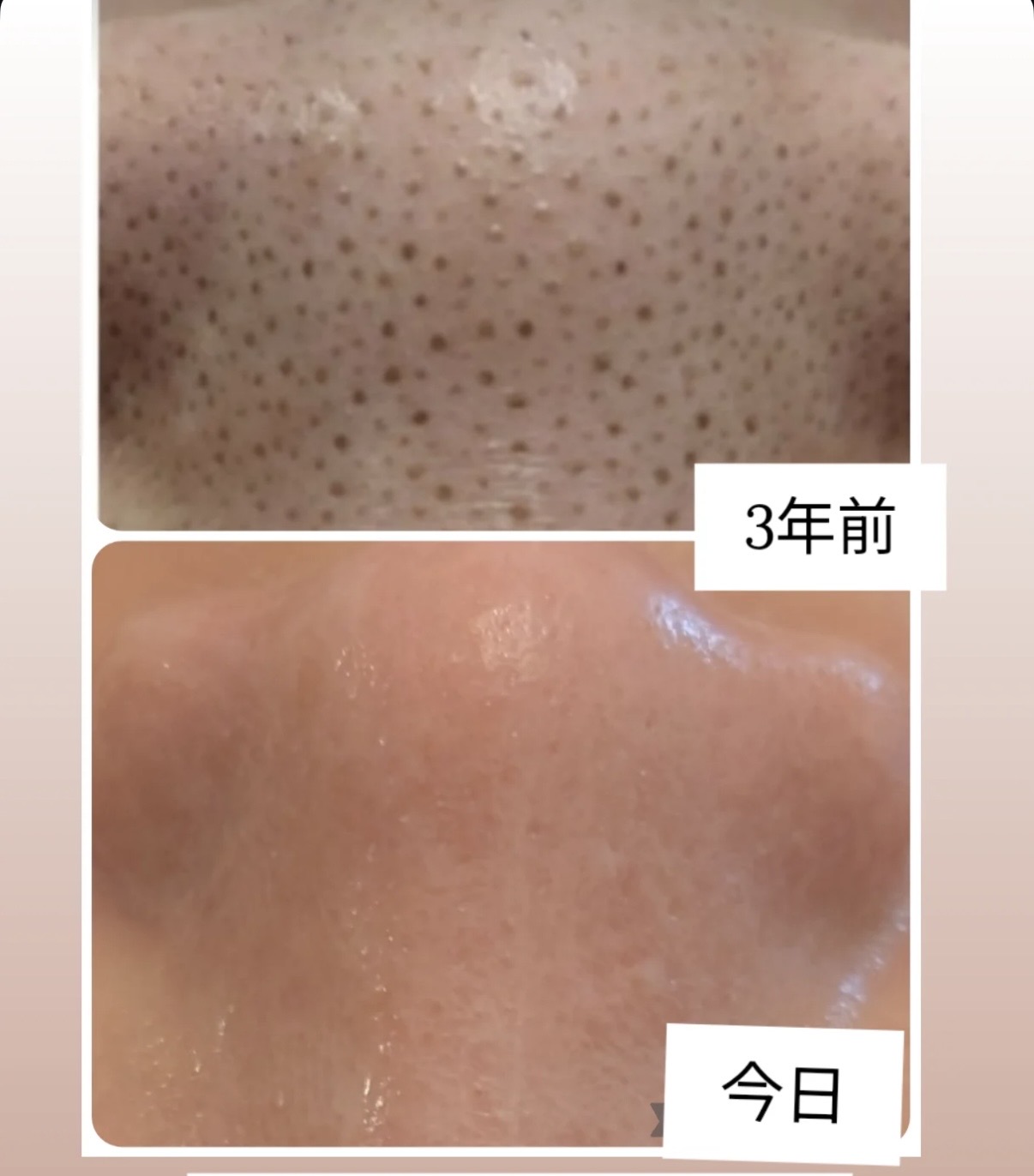 ウルティブライトで毛穴ケア✨