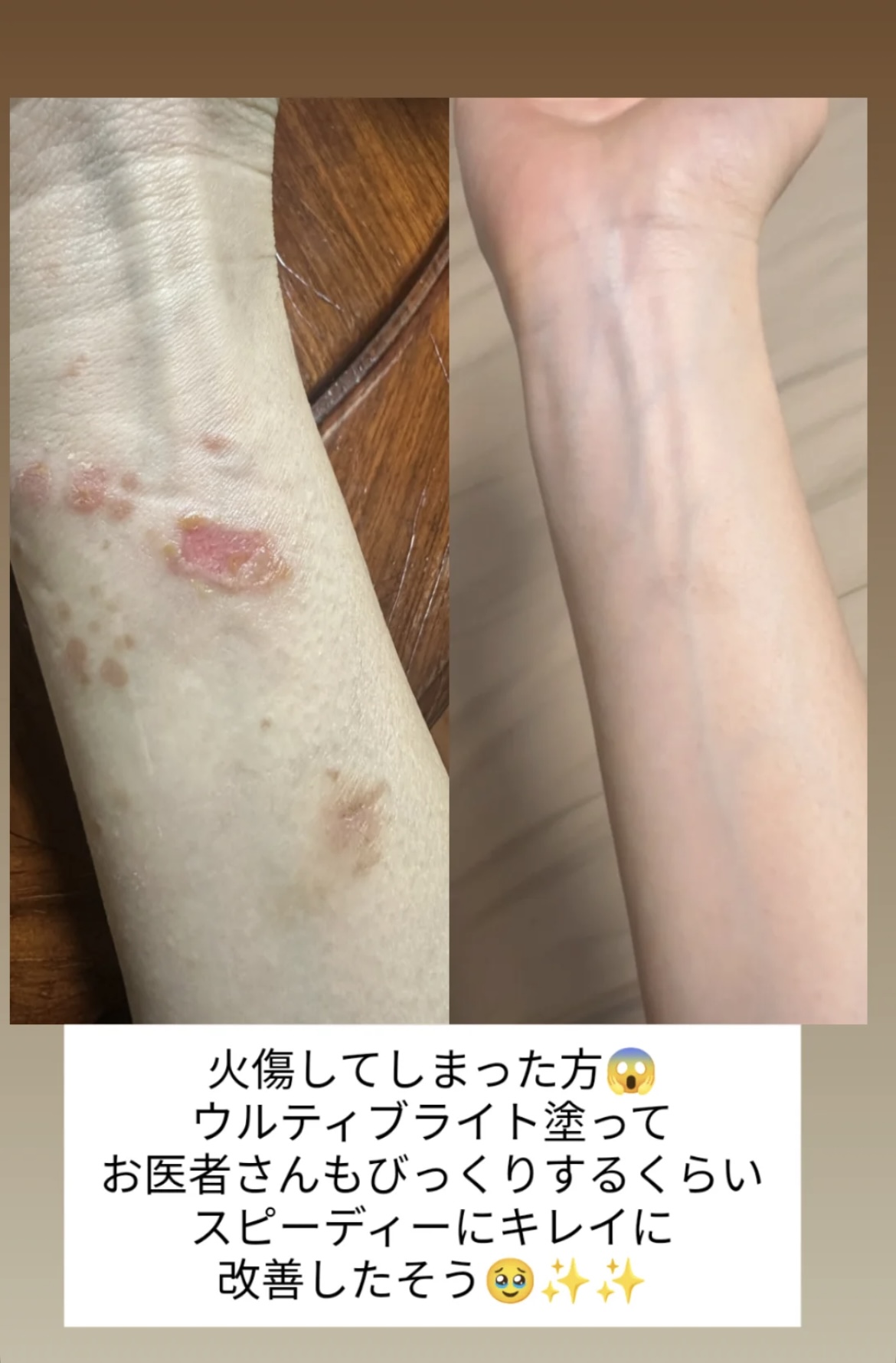 火傷にウルティブライト🩷