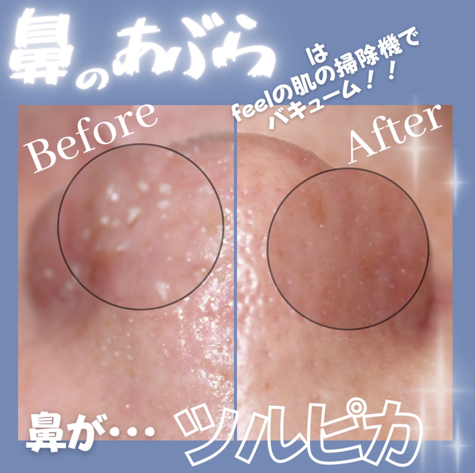 feel大人気メニュー❣️ 【毛穴吸引】🤍✨