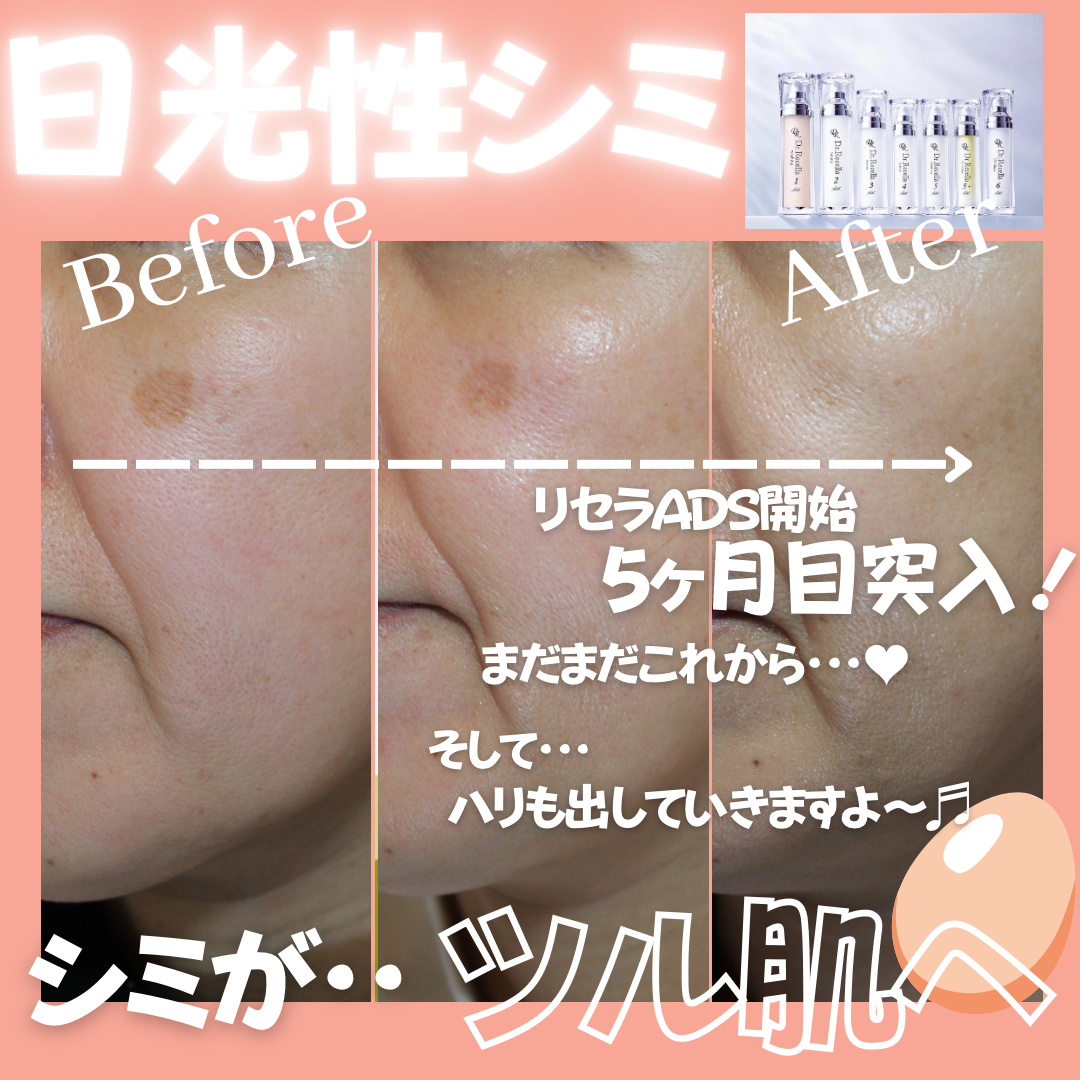 エステとリセラADSを開始して5ヶ月目に突入👆🏻 🤍