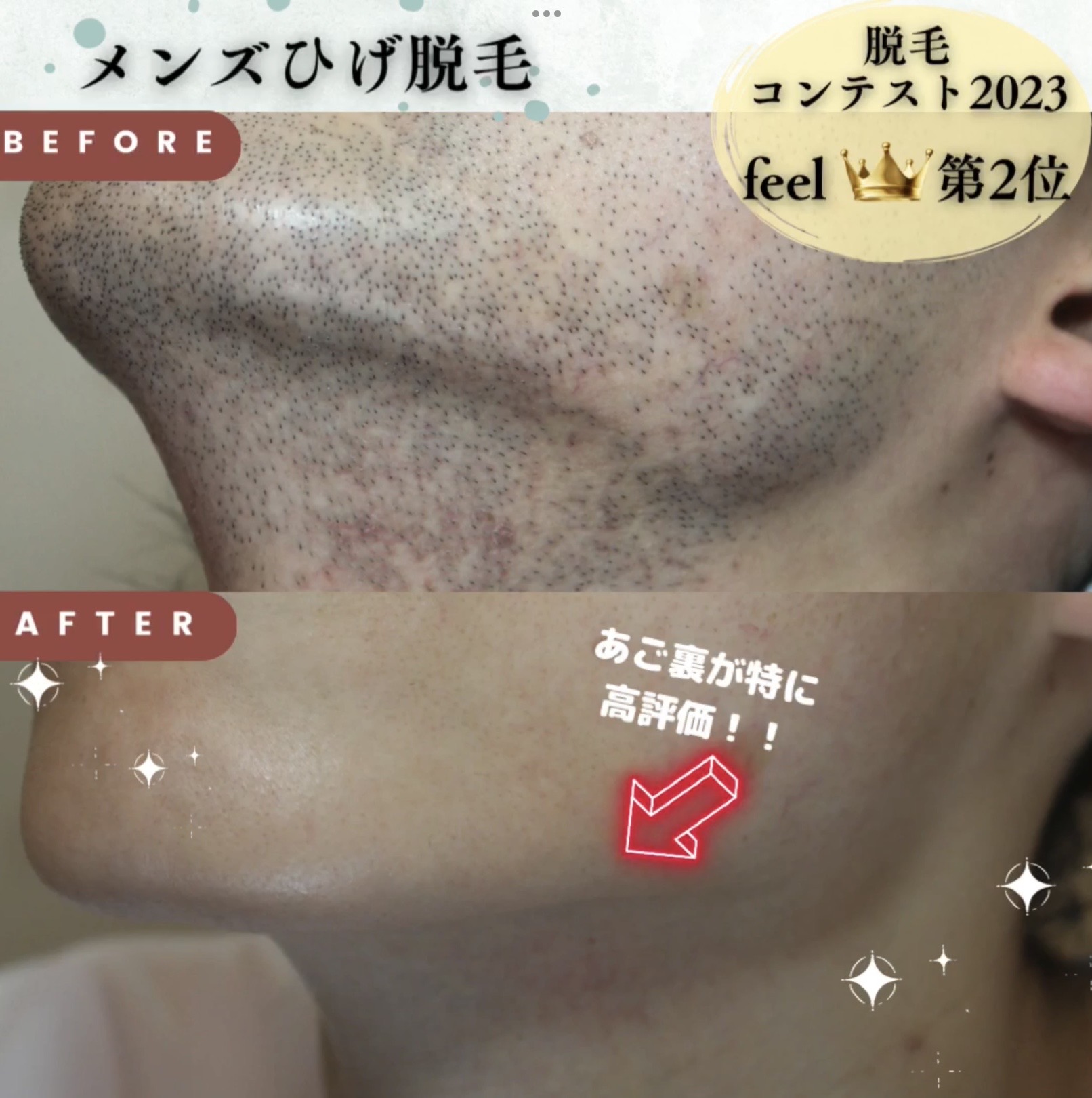 【💎脱毛コンテスト 2023💎】