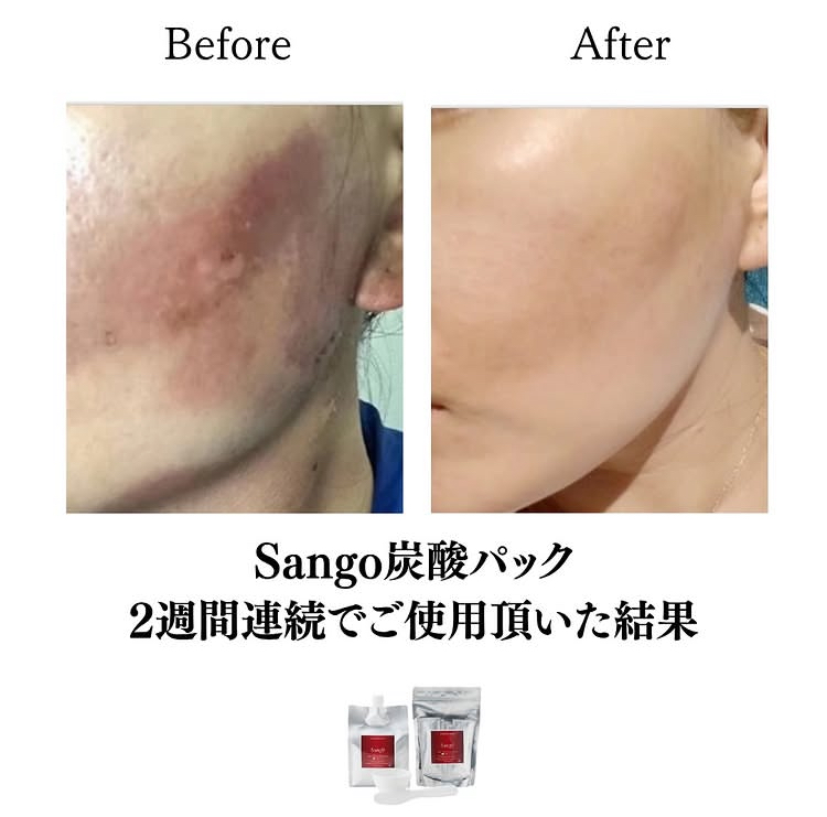 うっかり日焼けも怖くない！「あ、焼いちゃった…」をなかったことにするレスキューパック✨