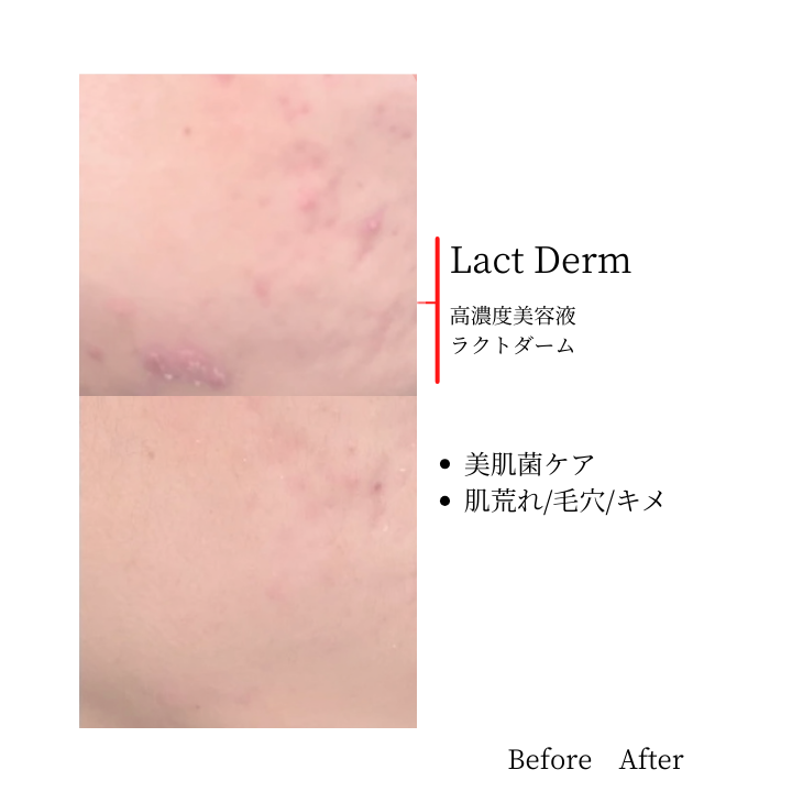 ラクトダーム|Before After