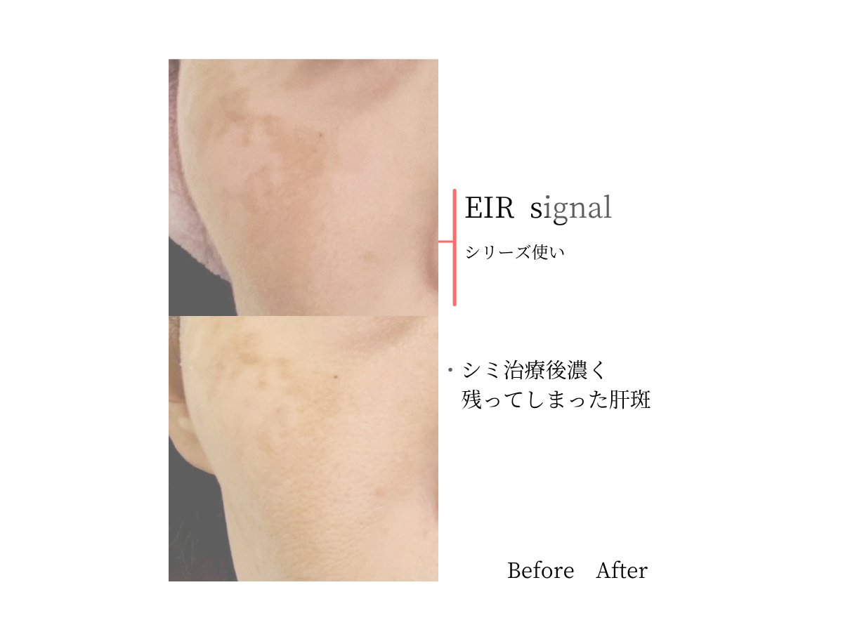 美白ケアで悪化してしまった肌| 3ヶ月でここまで変化