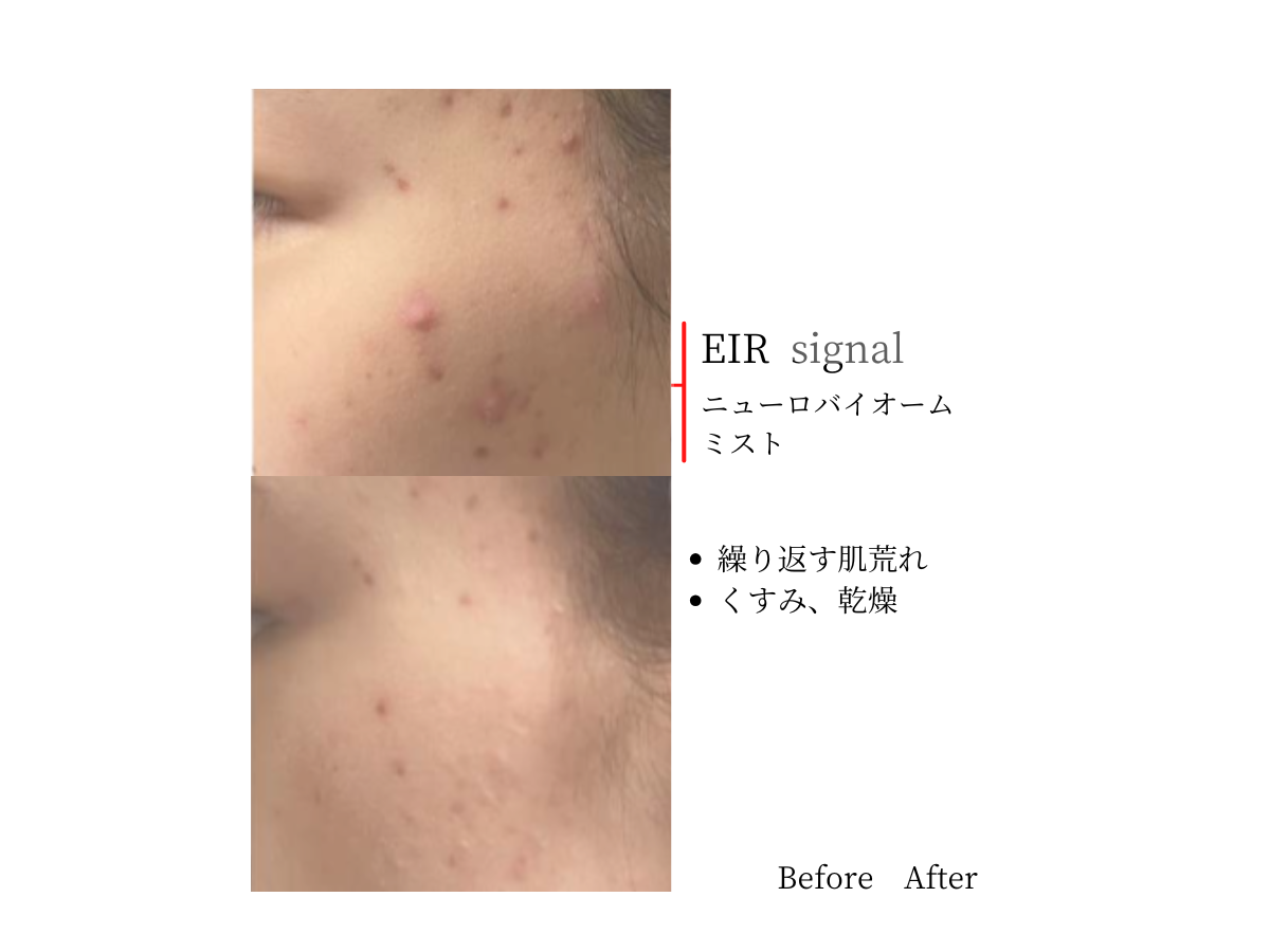 肌荒れ・赤み・くすみに|EIRミスト