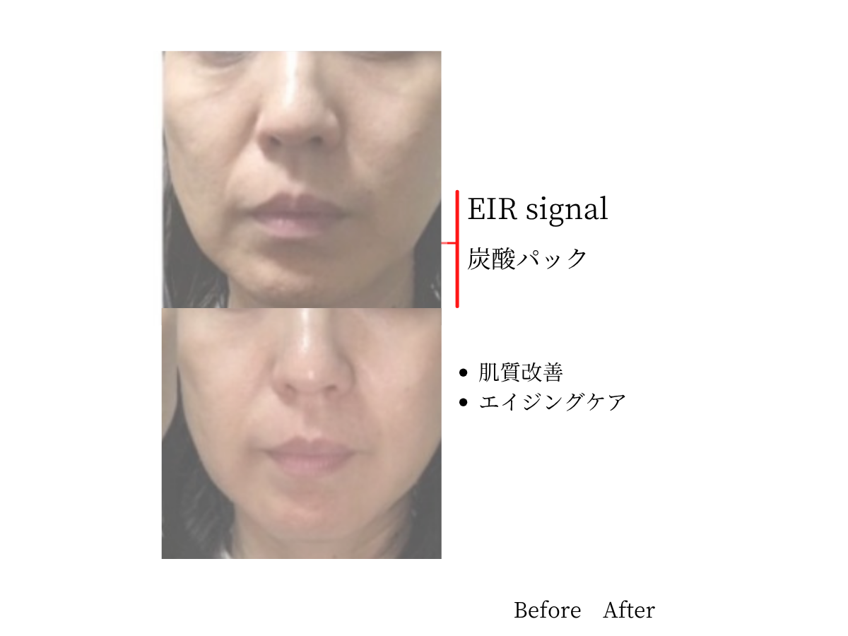 EIR炭酸パック|Before After