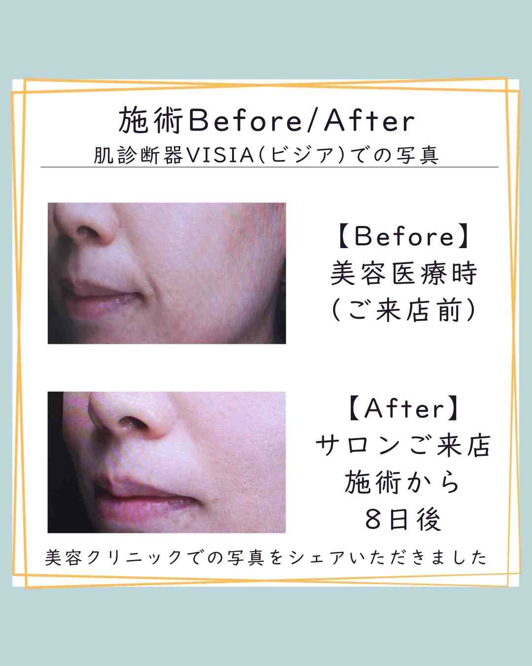 肌がふっくら整う理由。たるみ・ほうれい線のBefore→Afterに学ぶ“内側からのケア”とは？