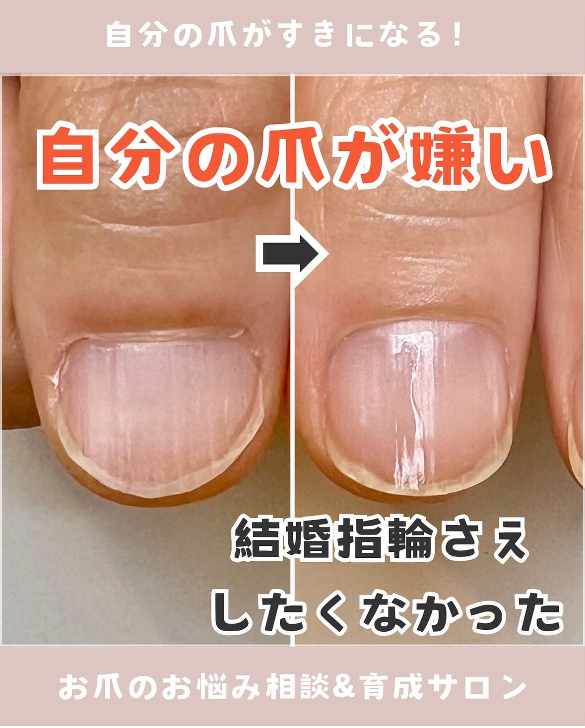 自分の爪が好きになる！むしり癖改善とモニター募集