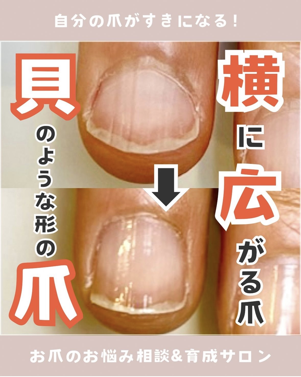 自爪育成で貝のような横広がりの爪が変わる！