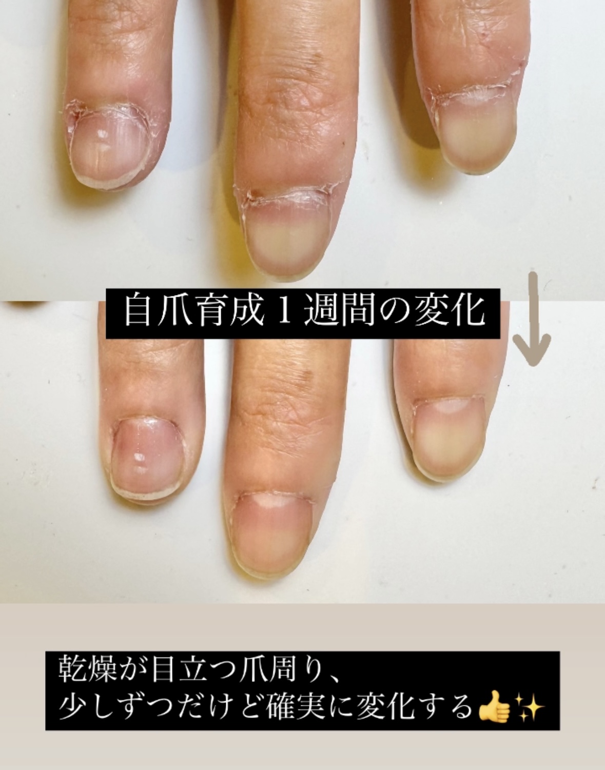 モニター C様【お悩み】噛み爪、ささくれ、手荒れトラブル