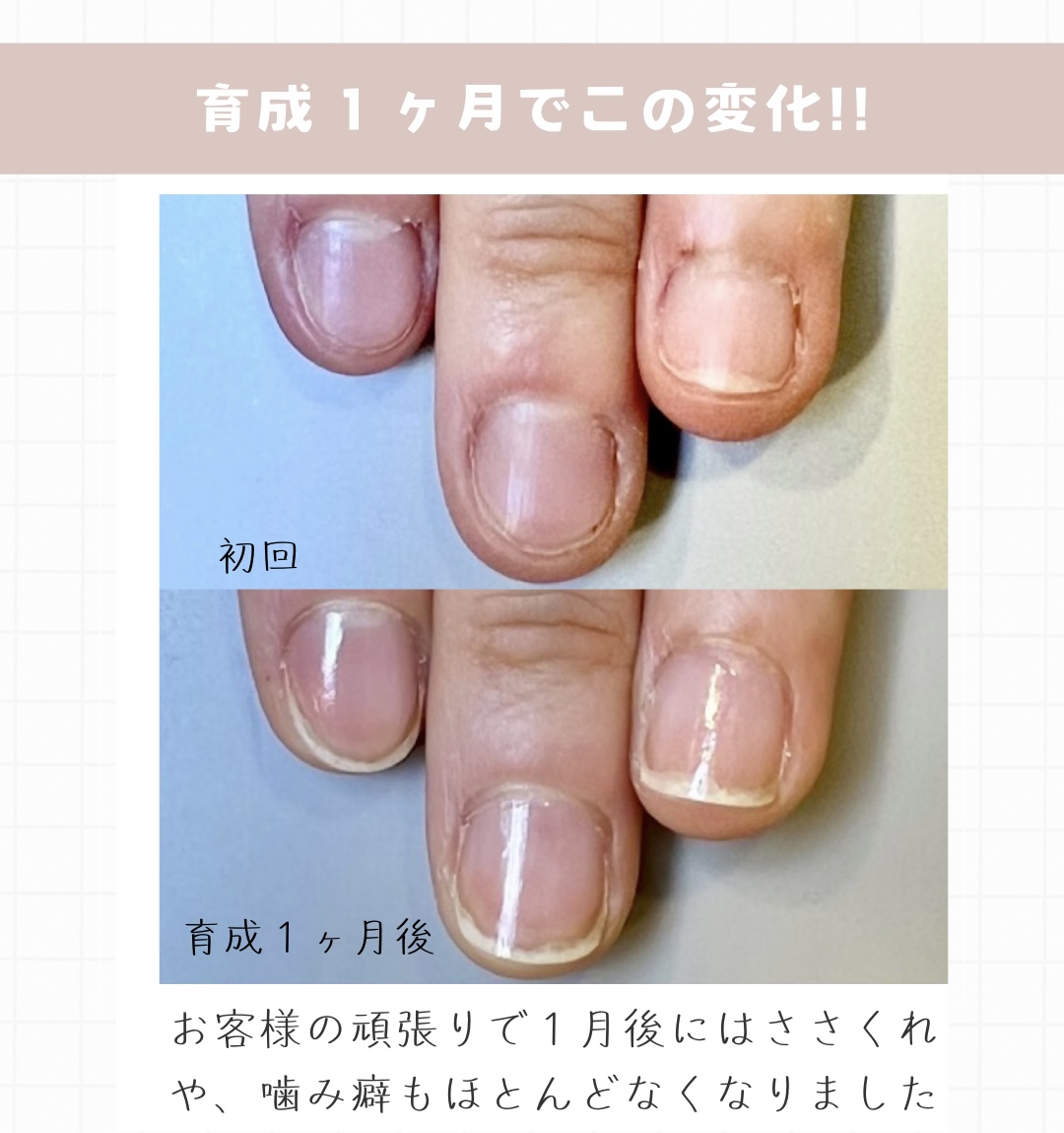 １ヶ月でこんなに変わる！自爪育成モニターの驚きのビフォーアフター