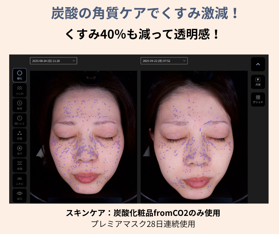ビフォーアフターまとめ【fromCO2でこんなお肌の変化！肌診断の器械の写真】