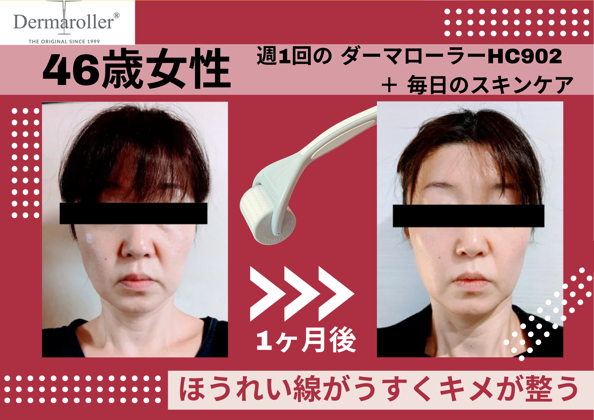 【自宅でここまで変わる？】話題のダーマローラー× スペシャルマスクで肌が目覚める理由