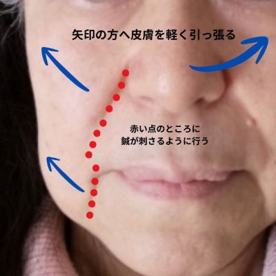 【鍼灸師が伝授】ダーマローラーを「お悩み別」に使い分ける！効果を最大化するプロの裏技