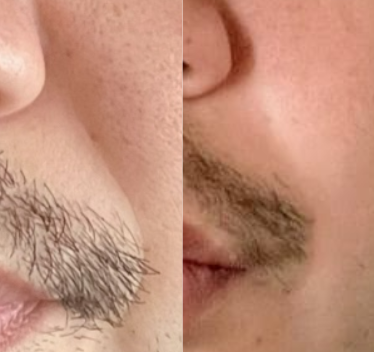 【実録】深く刻まれた「ほうれい線」は変わるのか?プロが自ら証明した3ヶ月の記