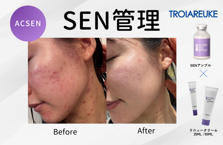 何をしてもダメ！そんなお肌の救世主「SEN管理」