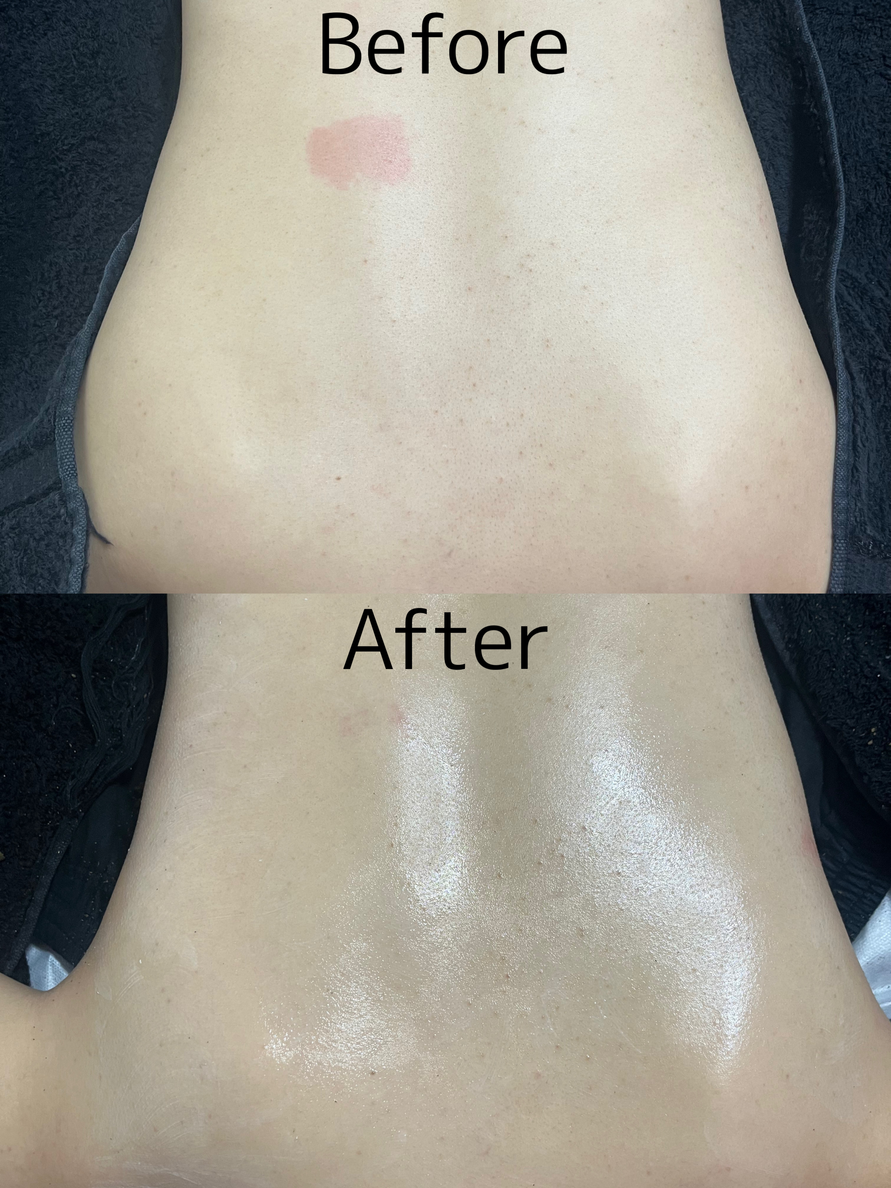 【ハーブピーリング症例】お背中ケアもお任せ下さい🩷