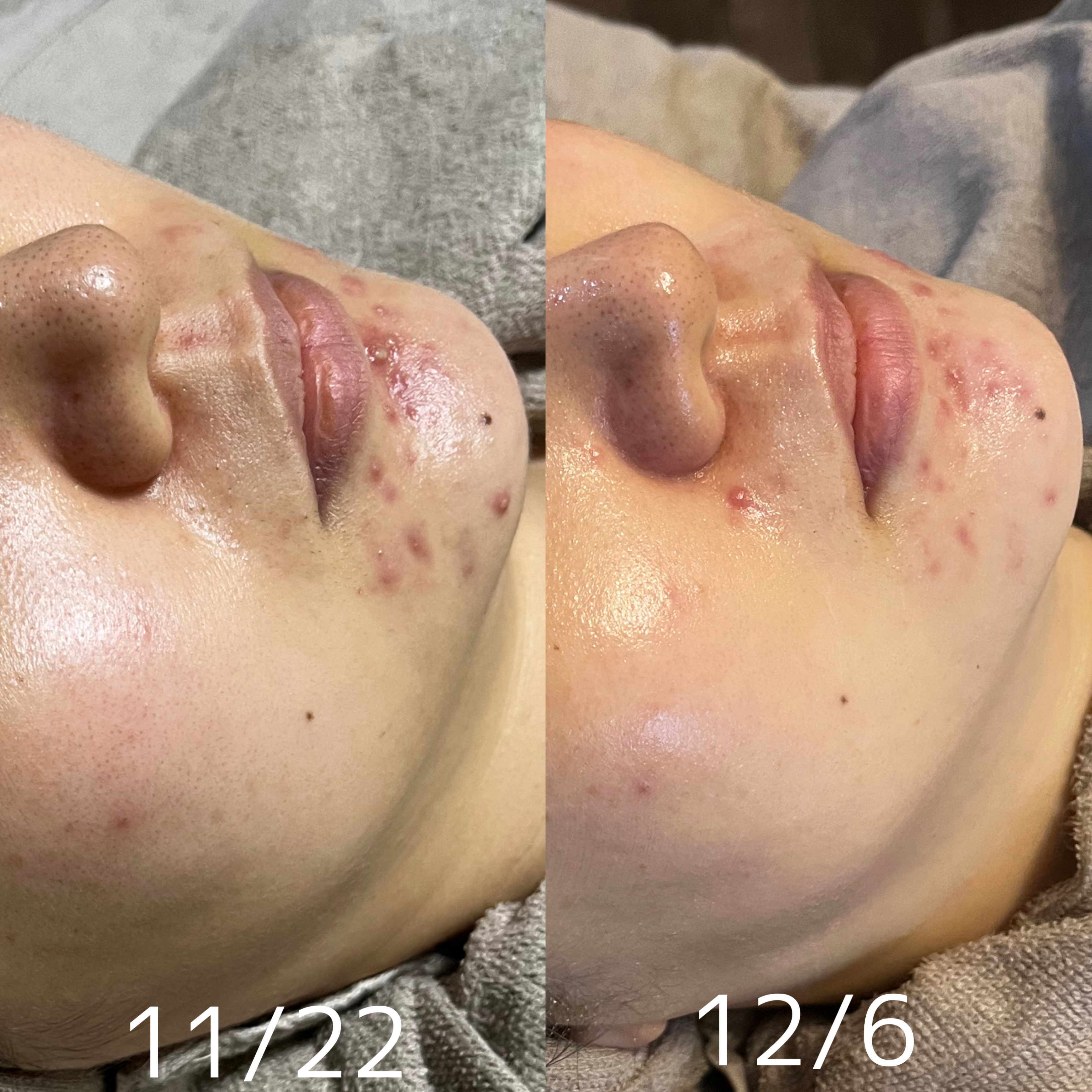 【ハーブピーリング症例】繰り返す顎ニキビ2週間経過