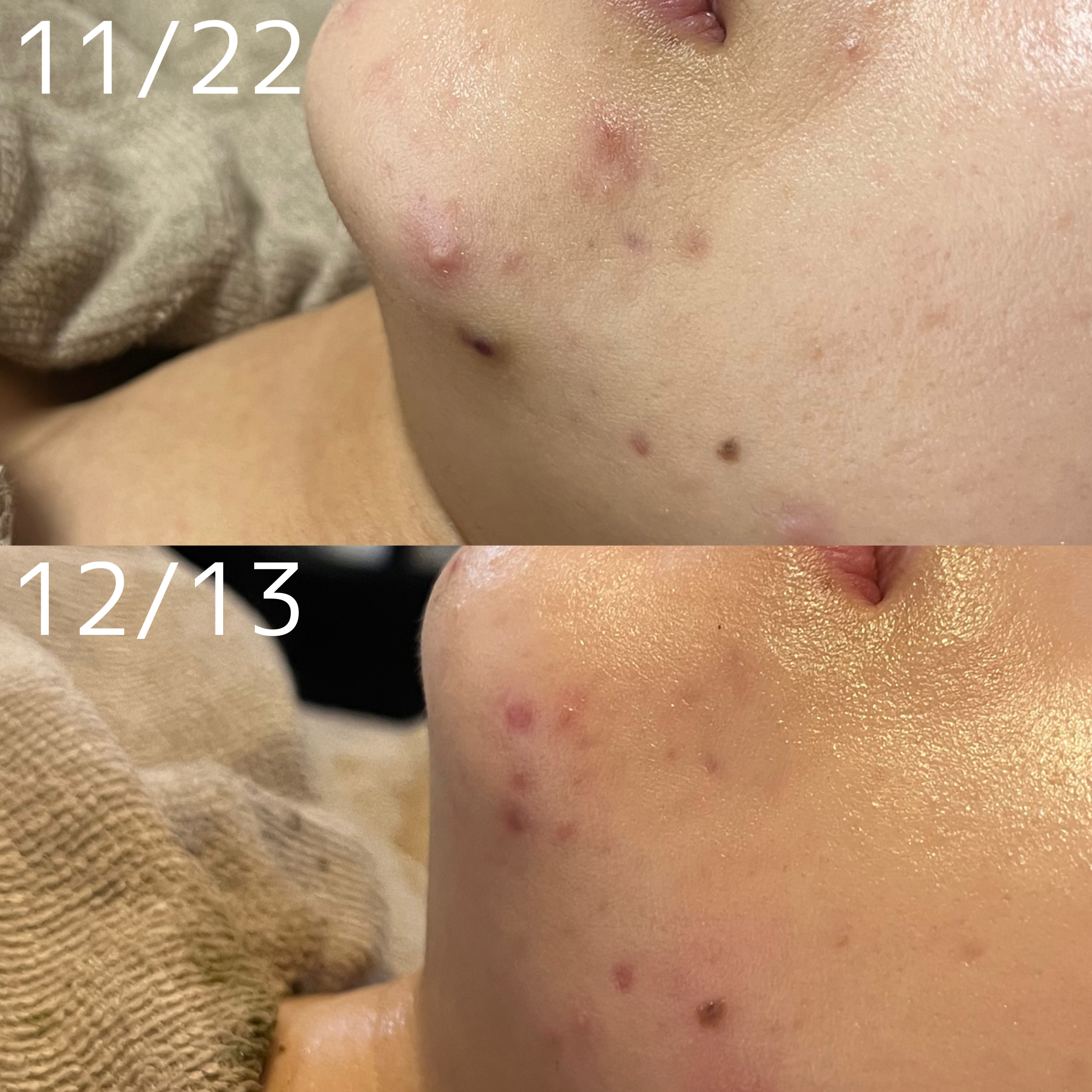 【ハーブピーリング症例】粉瘤？ニキビ？3日後には鎮静