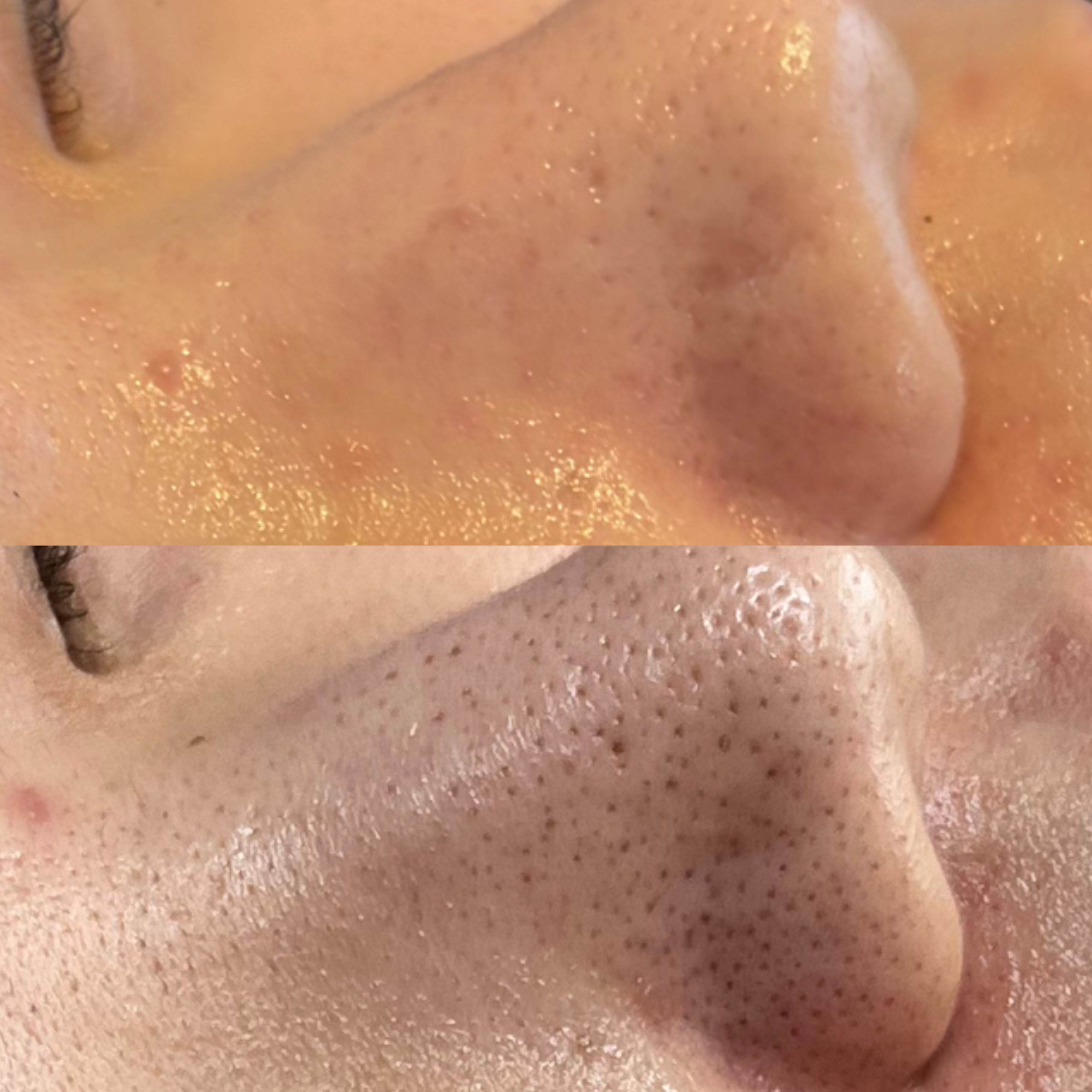 【ハーブピーリング症例】毛穴洗浄無し！大分の肌質改善サロンで毛穴改善