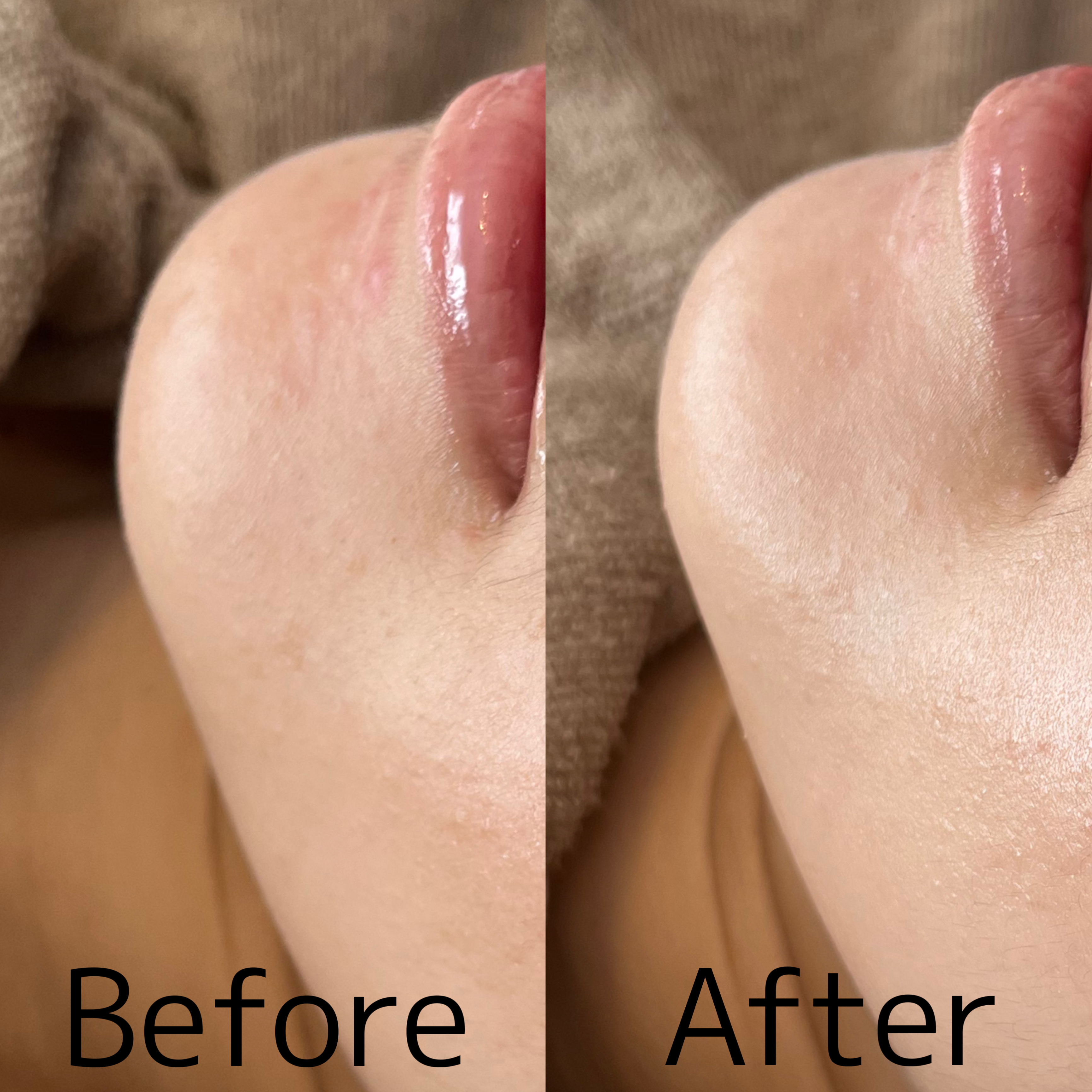 【陶肌ピール症例】第5世代のピーリングも大人気  #大分REVI販売会社