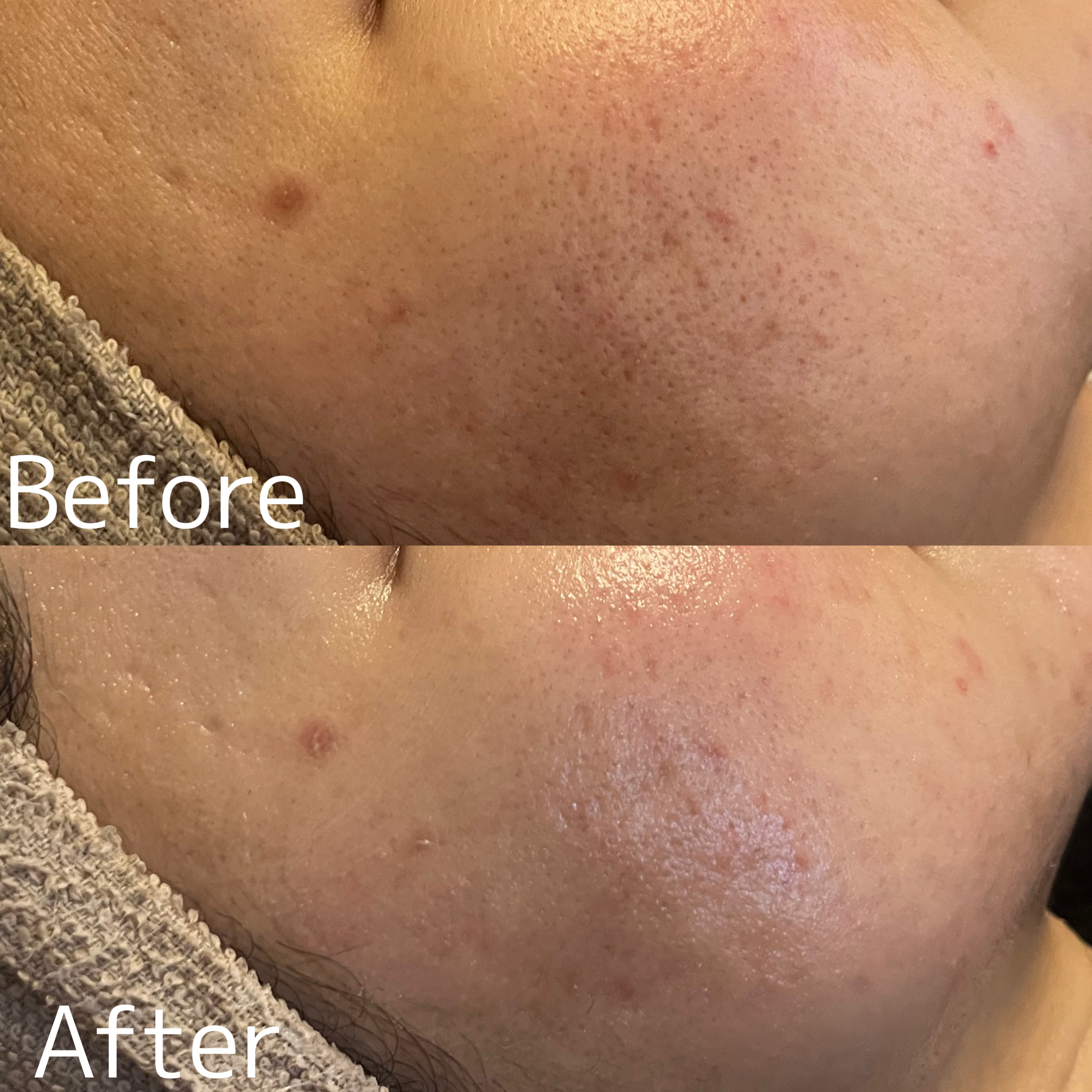 【ハーブピーリング症例】大分のニキビケアはお任せ下さい！