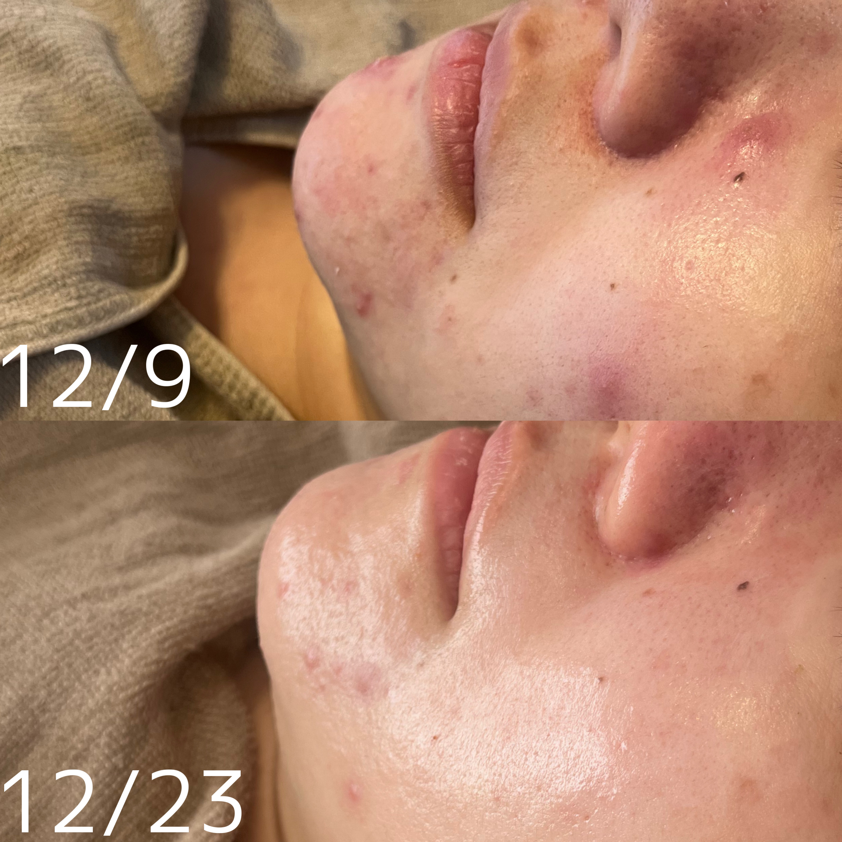 【REVIハーブピーリング症例】年始から続々とご来店ありがとうございます😊#大分REVI