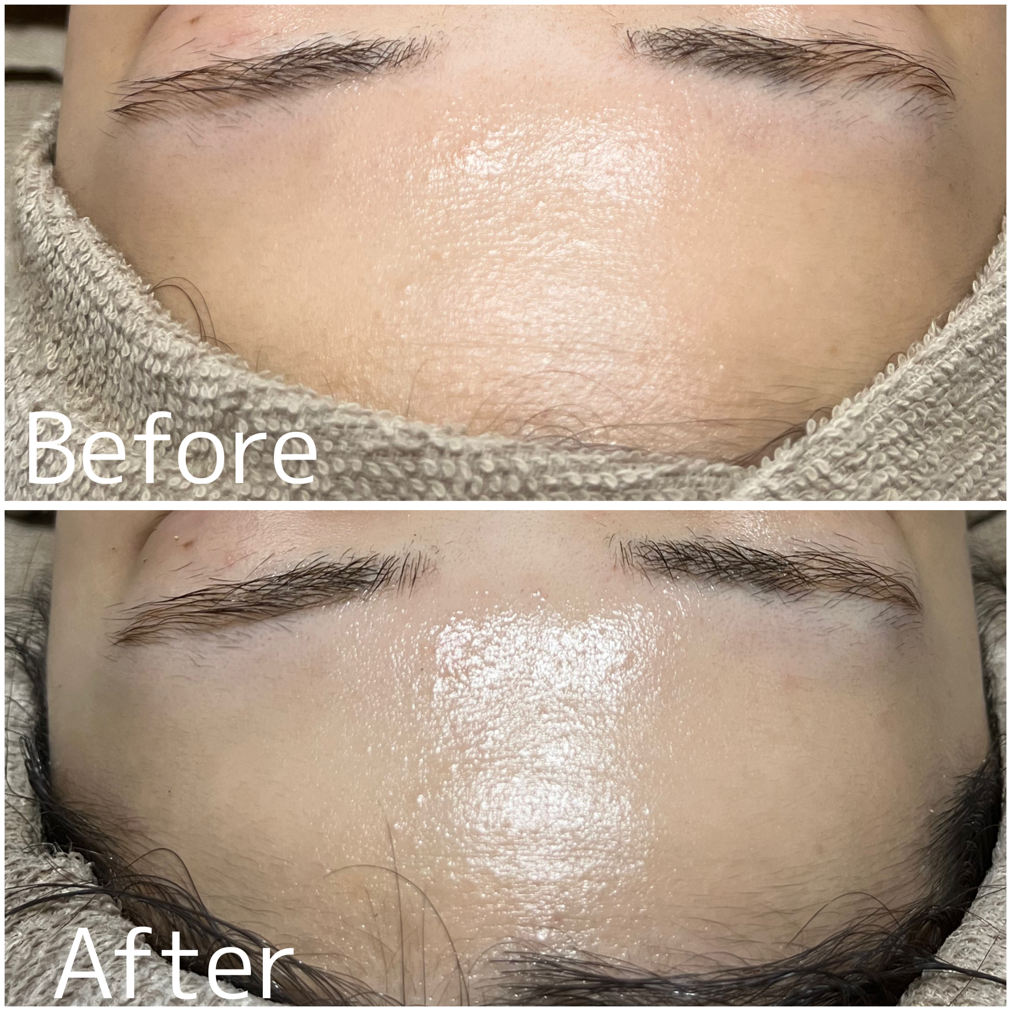 【ハーブピーリング症例】20代も冬のくすみは大敵！