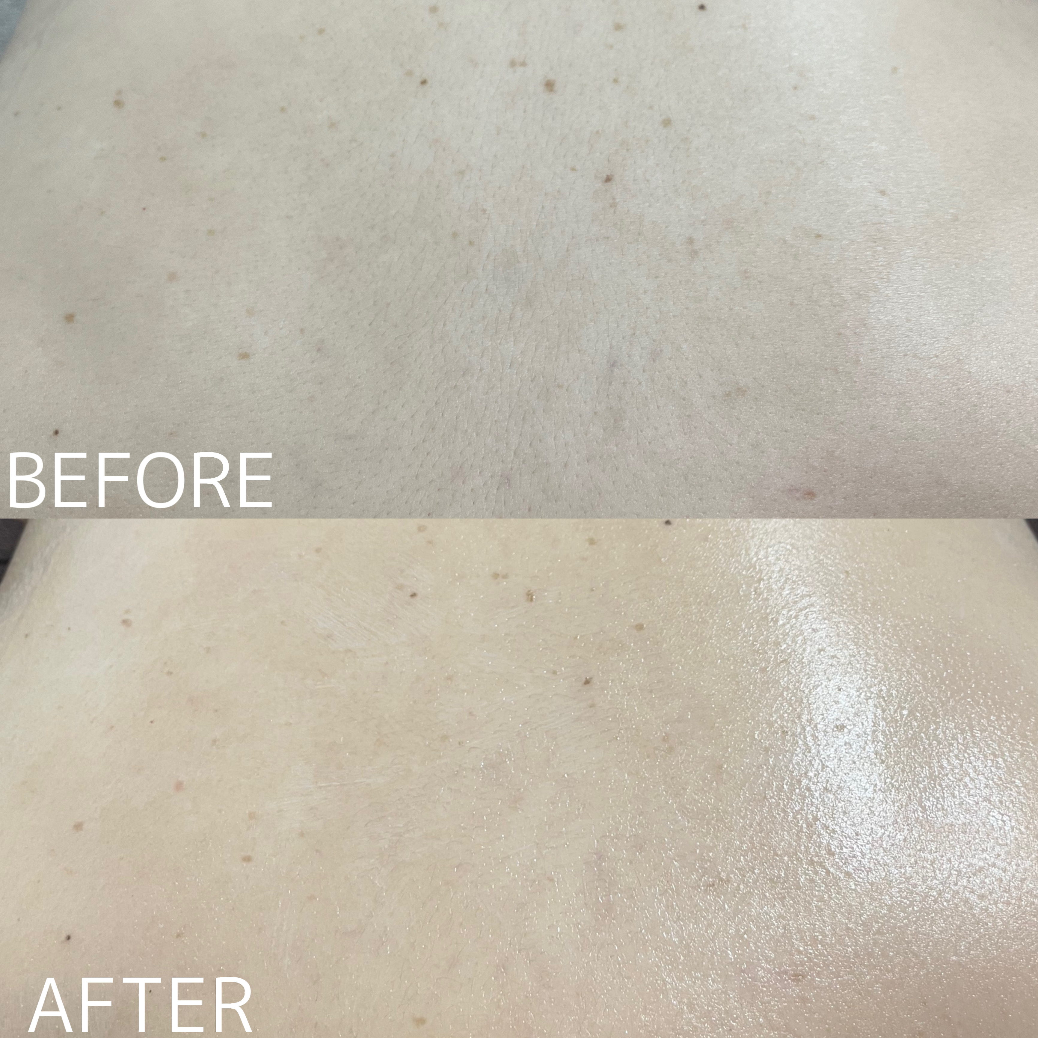 【ハーブピーリング症例】50代のお背中ケア#大分エステ