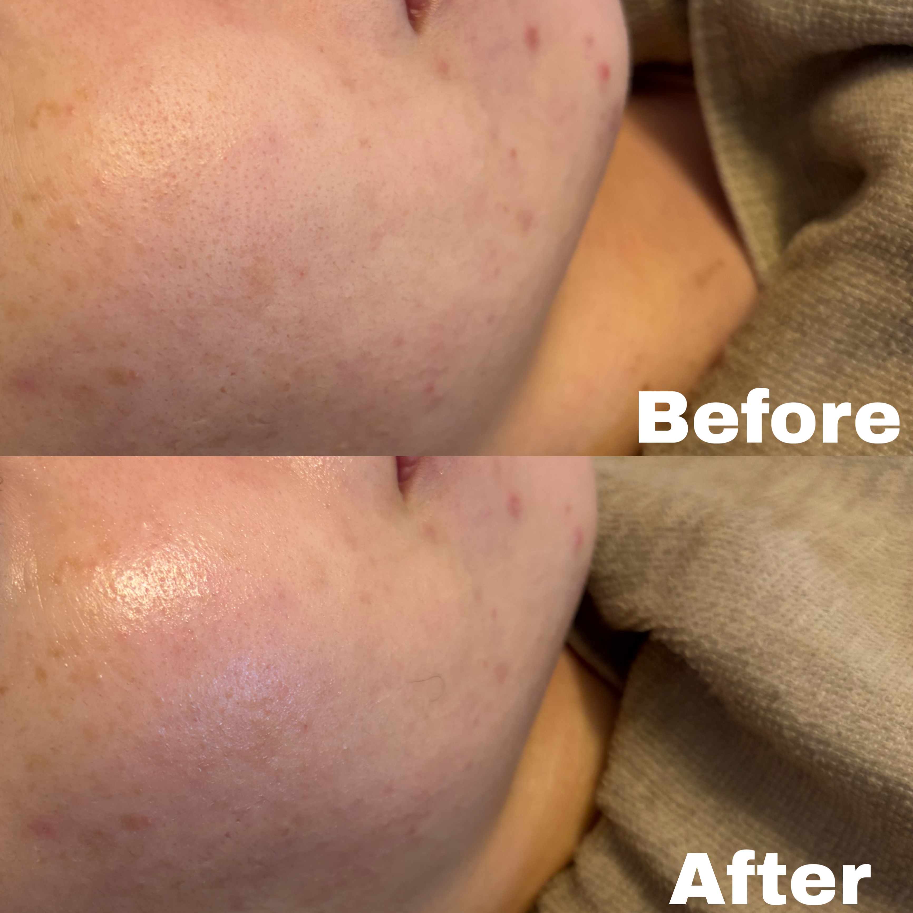 【ハーブピーリング症例】大分のニキビ/シミ/毛穴肌管理お任せ下さい！