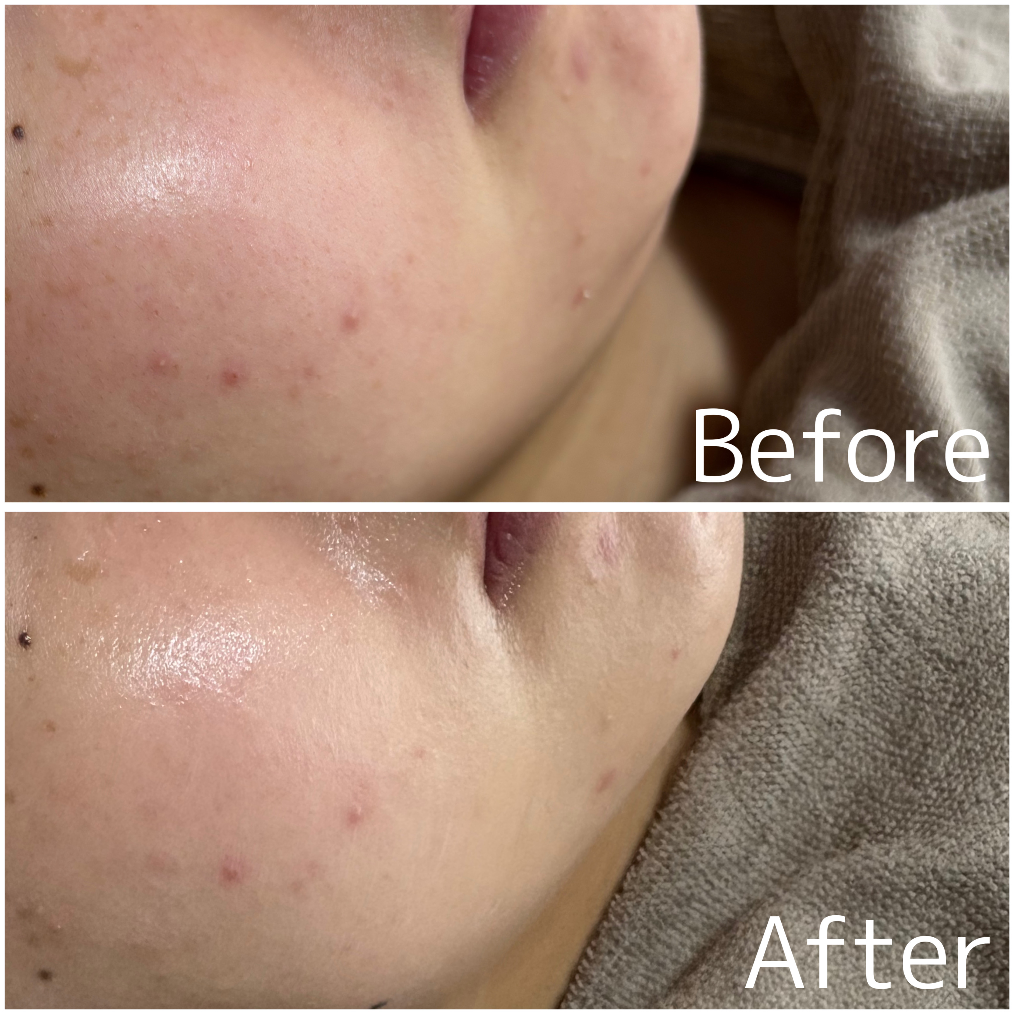 【ハーブピーリング症例】ニキビ・赤ら顔・小顔効果★