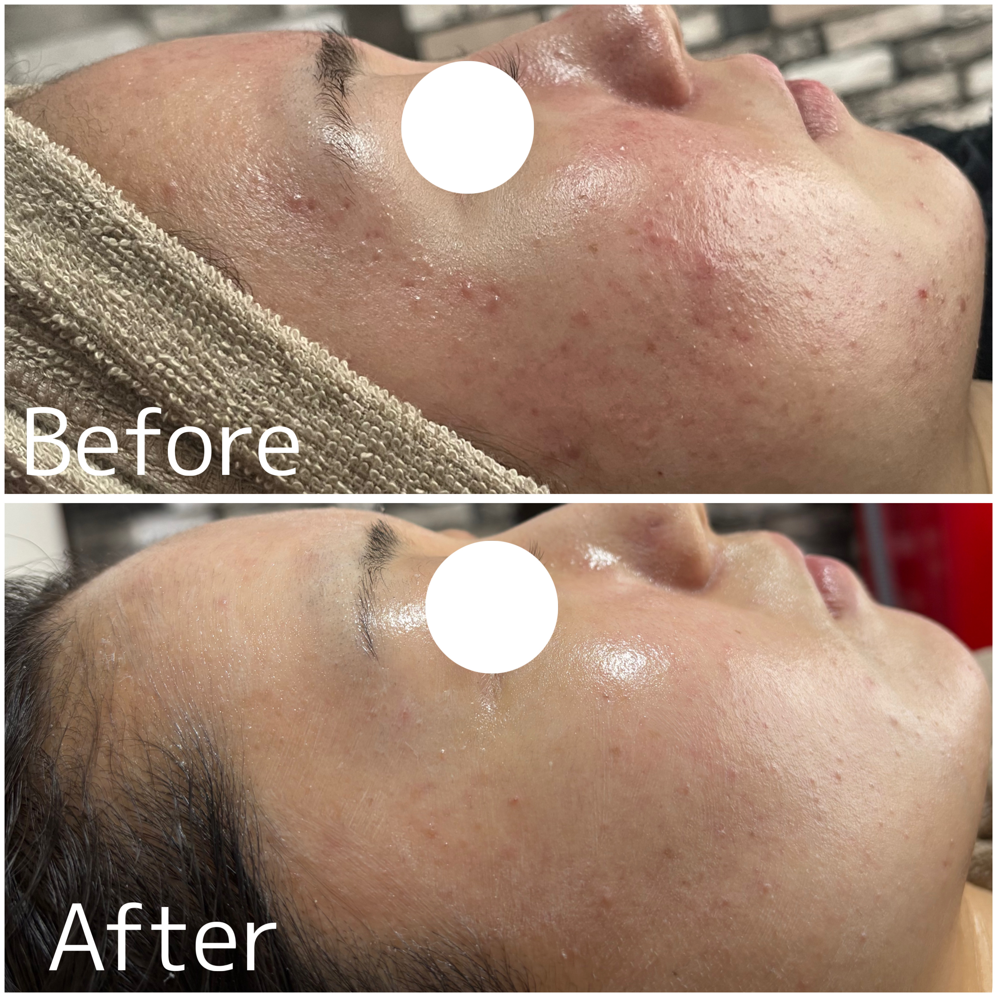 【陶肌トリートメント症例】10代特有のニキビ・肌荒れ・赤みのあるダメージ肌