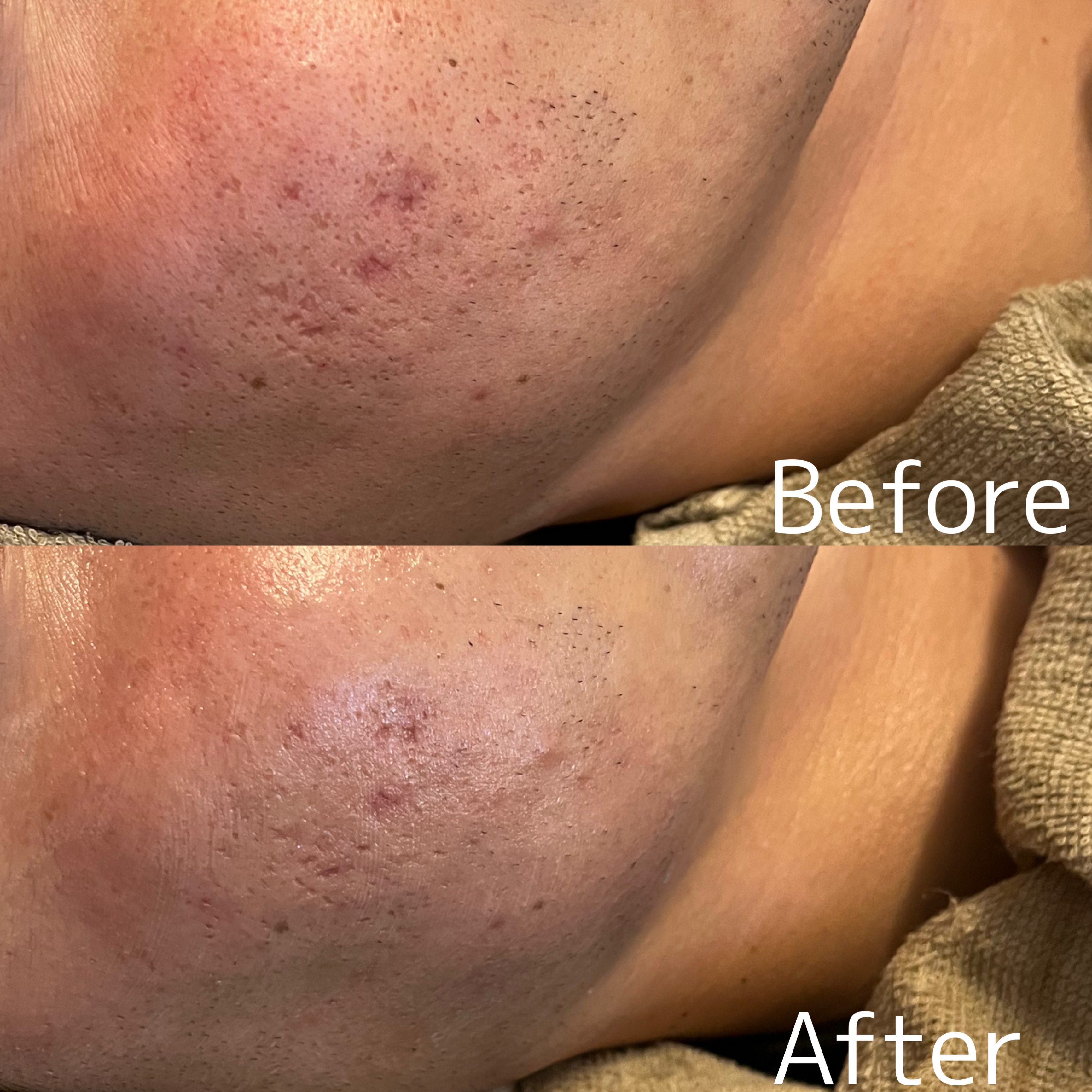 【ハーブピーリング症例】フルオプション1回★#大分エステ