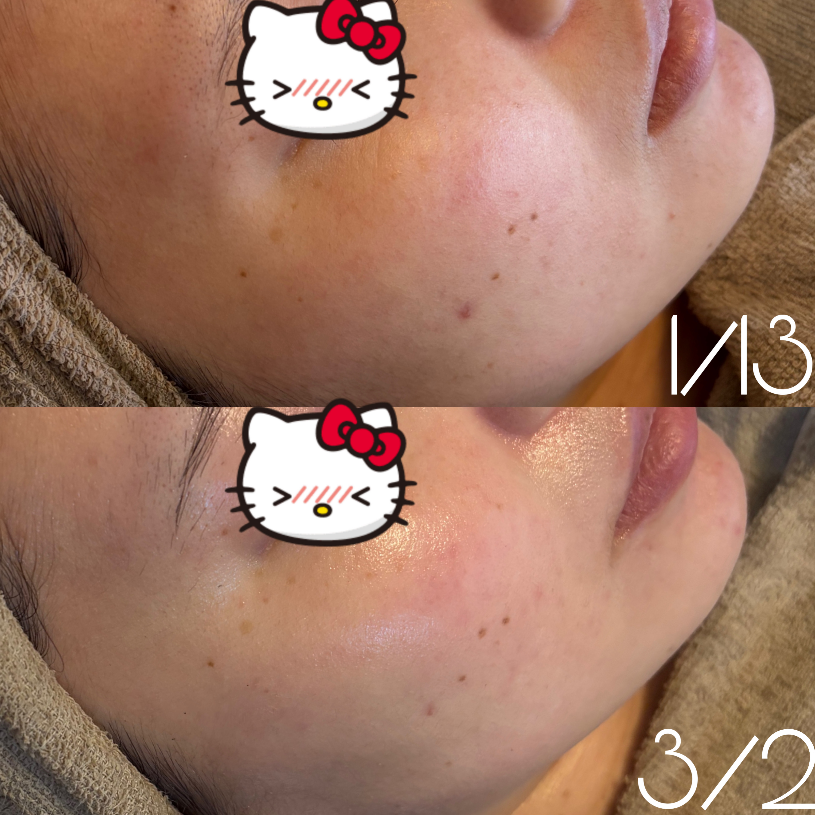 大分のニキビ肌質改善サロン／リニューアルしました★